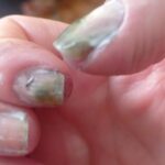 Paciente com unhas frágeis e quebradiças antes do tratamento dermatológico.