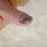 Unha frágil e lesionada antes do tratamento médico conduzido pela dermatologista Dra. Carolina Borba em Salvador.