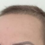 Paciente após início do tratamento dermatológico em Salvador com cabelo voltando a crescer de forma saudável.