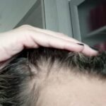 Paciente com couro cabeludo visivelmente ralo antes do tratamento.