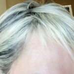 Paciente após tratamento com fios loiros fortes e couro cabeludo saudável.