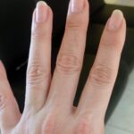 Paciente após tratamento dermatológico com unhas fortes e saudáveis.